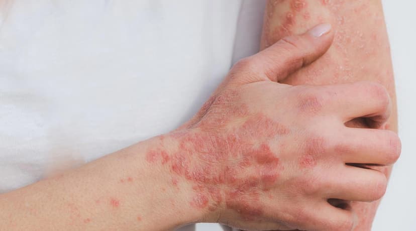 Best Countries for Psoriasis Treatment Abroad