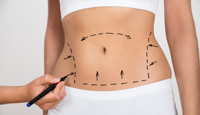 All-Inclusive Tummy Tuck in Turkey: Costs, Clinics, Packages