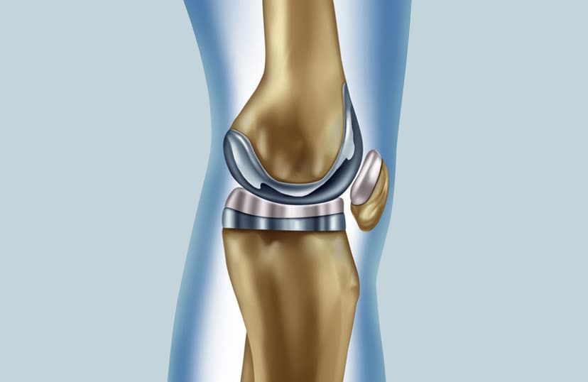 Best and Cheapest Countries for Hip Replacement Surgery Abroad