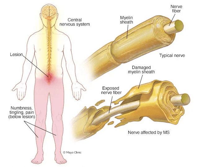 Multiple sclerosis medical condition