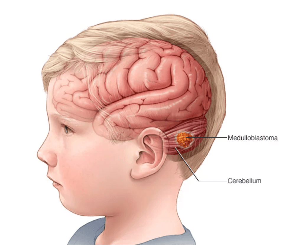 Medulloblastoma medical condition