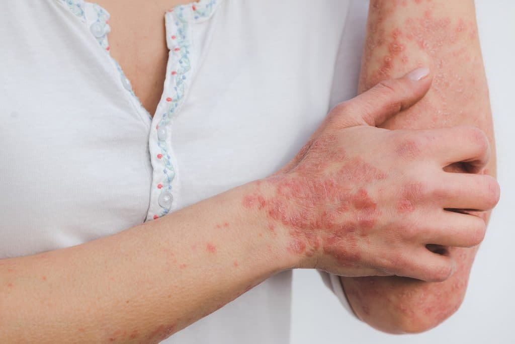 Best Hospitals for Autoimmune Disease Treatment