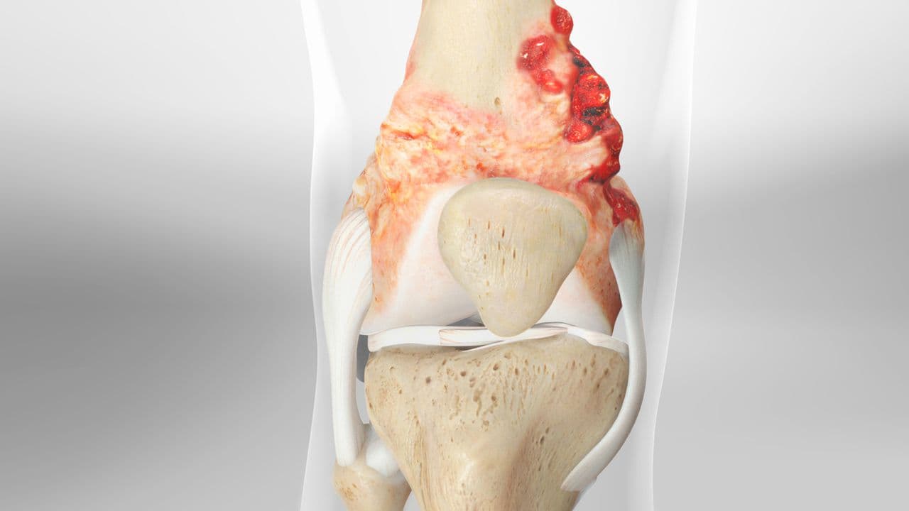 Best Clinics for Osteosarcoma Treatment Abroad