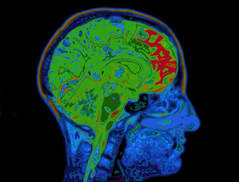 Meningioma (Brain Tumor) Removal Surgery in Turkey