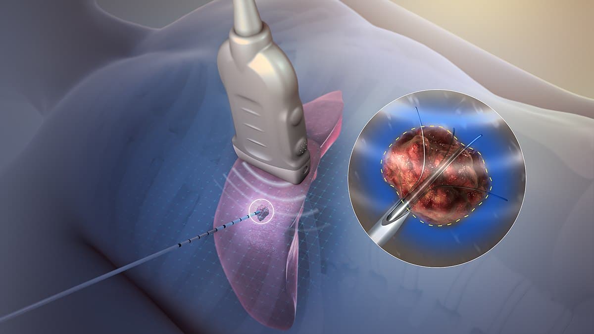 Radiofrequency Ablation in Turkey (Chronic Pain Treatment)