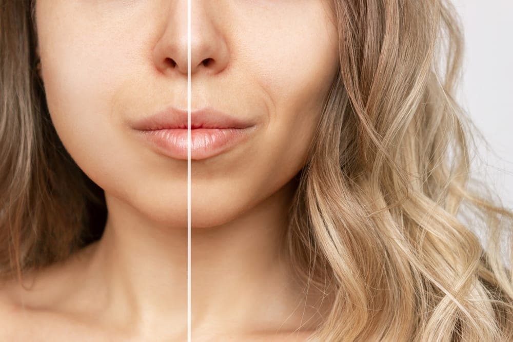 Buccal Fat Removal in Turkey (Bichectomy)