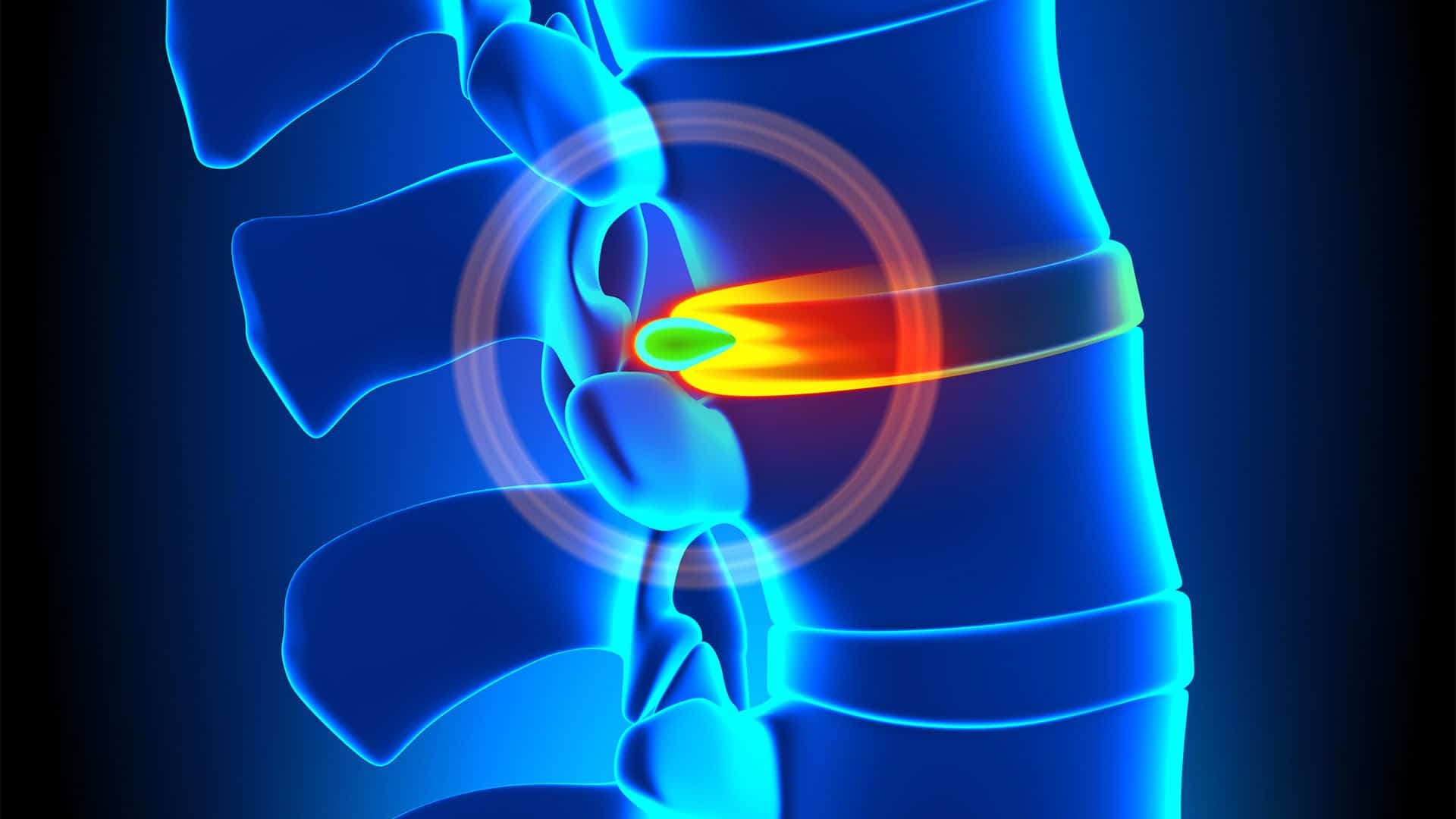 Best Hospitals Offering Stem Cell Treatment for Disc Injuries