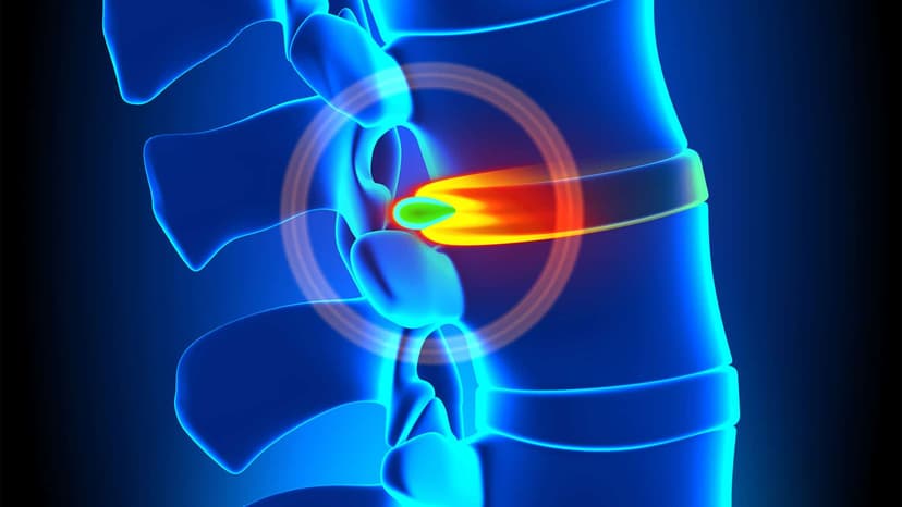 Best Hospitals Offering Stem Cell Treatment for Disc Injuries