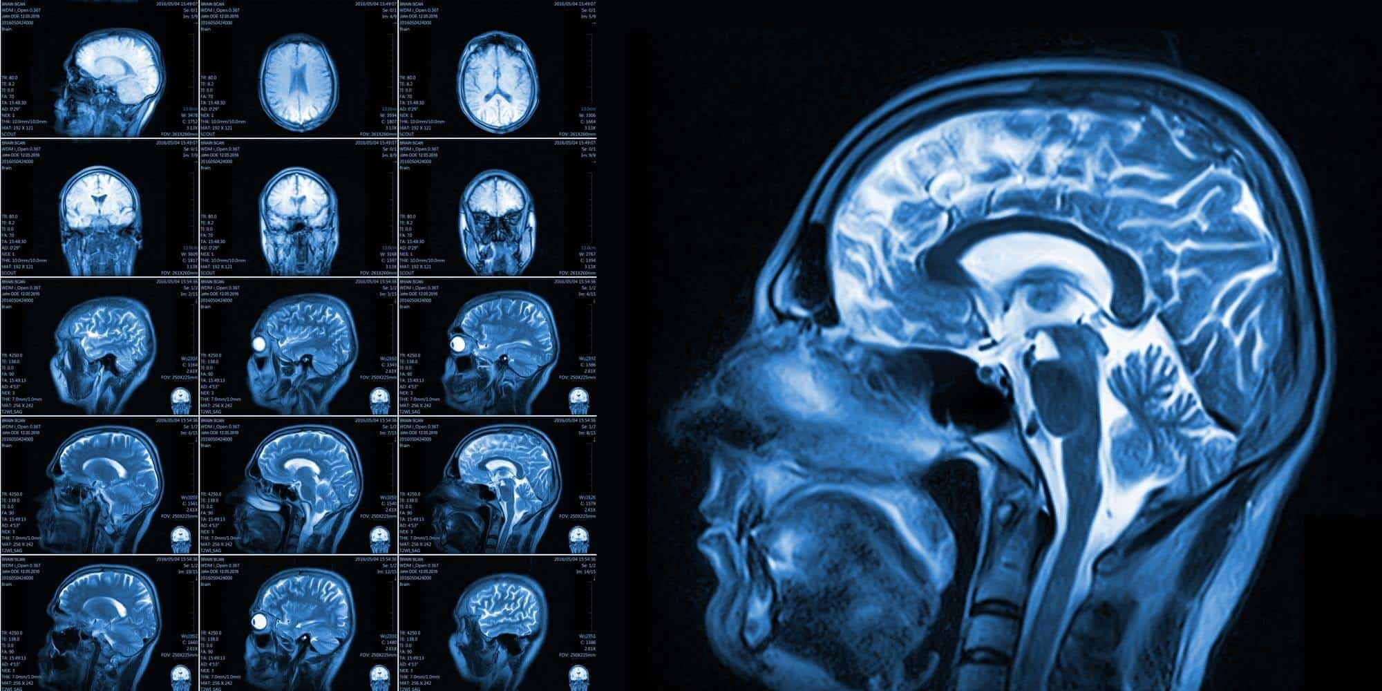 Deep Brain Stimulation in Turkey: A Complete Guide for 2026