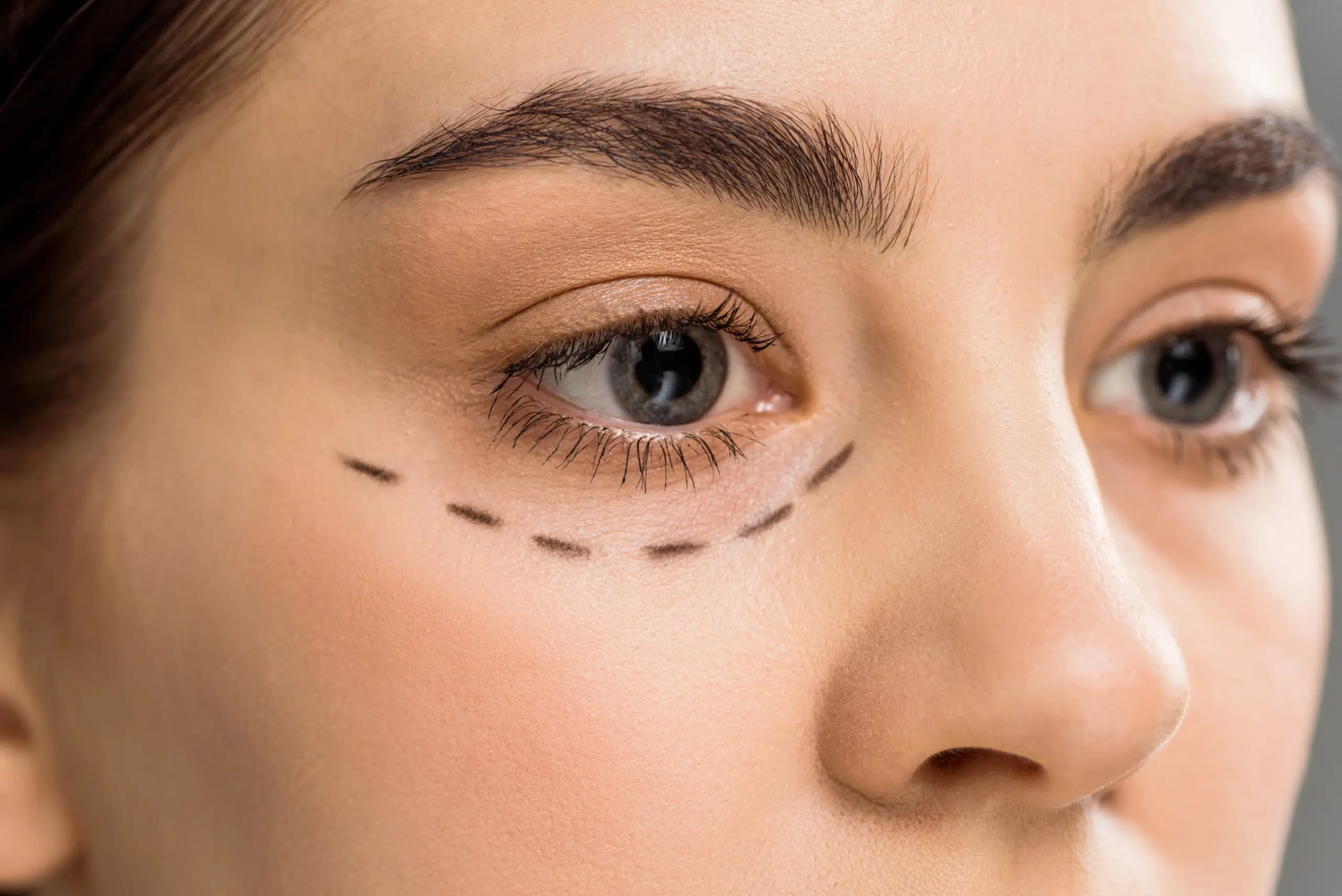 Best and Cheapest Countries for Eyelid Surgery