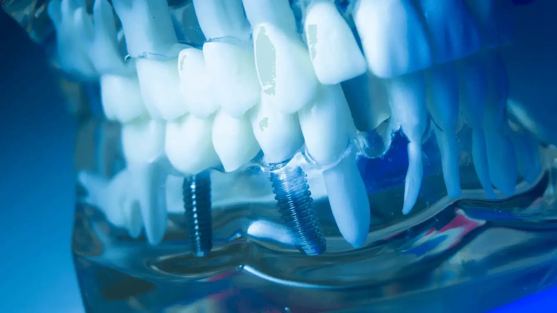 All-on-6 Dental Implants Poland