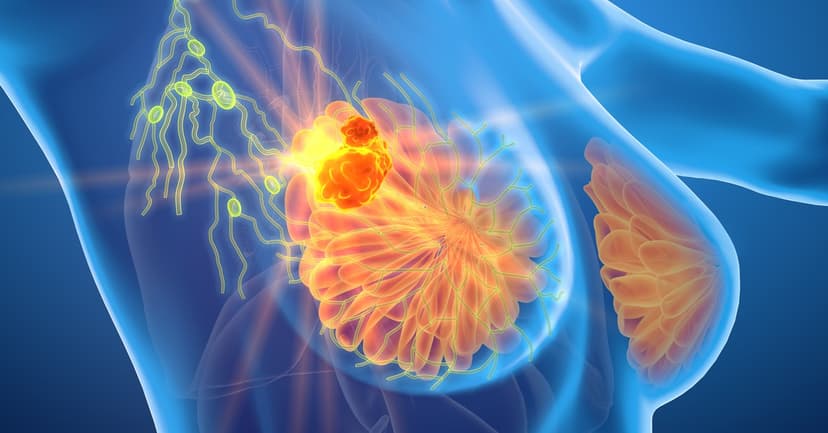 Guide to Stage 4 Breast Cancer Treatment Options Abroad