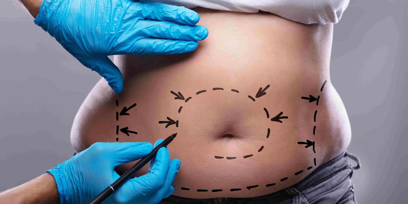 Best and Cheapest Countries for Tummy Tuck Abroad