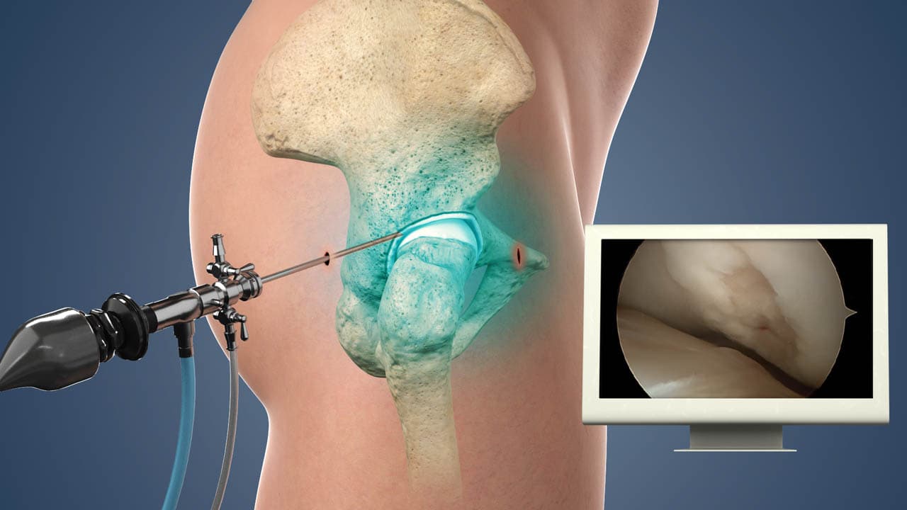 Hip Arthroscopy in Turkey