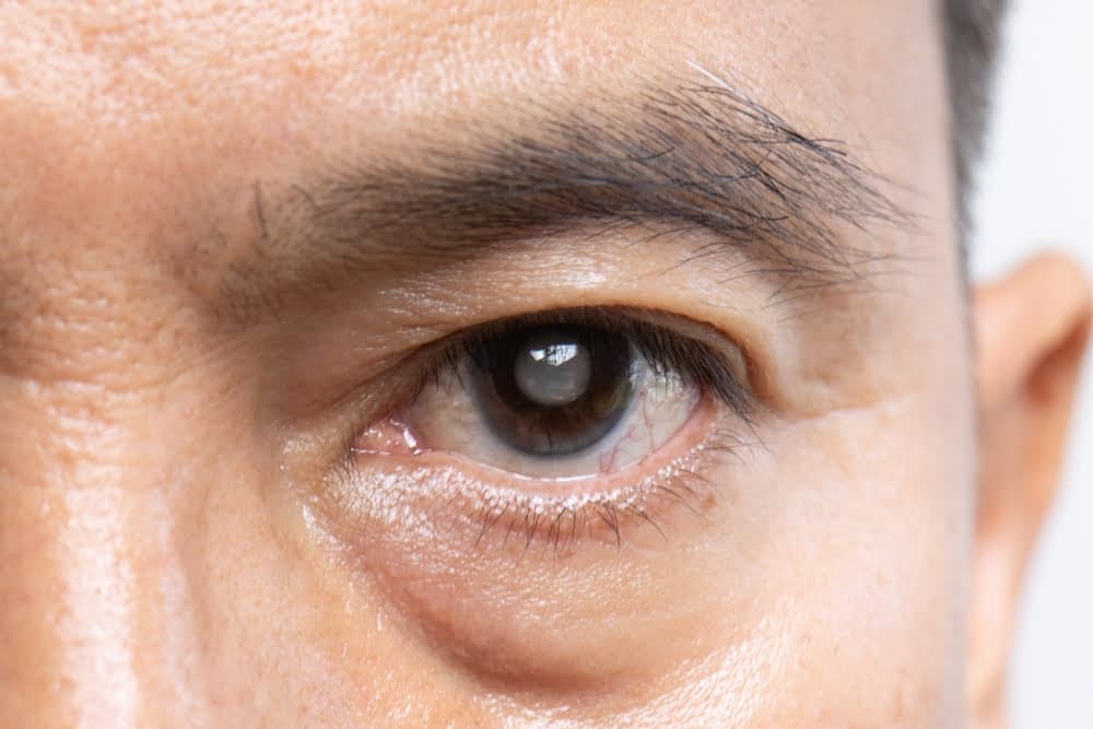 Cataract Surgery Cost in Turkey: Quality and Affordable Eye Care