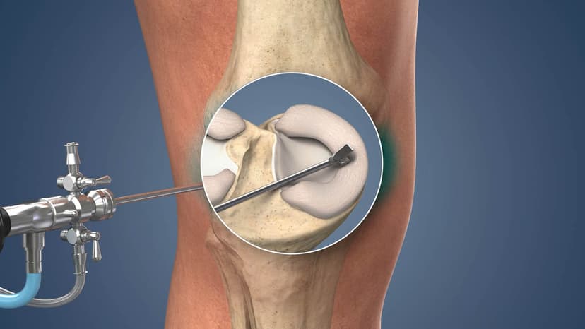 Meniscus Replacement in Turkey