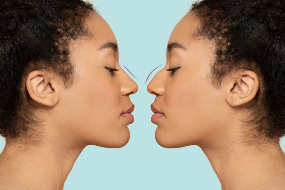 Nose Job Turkey - Affordable Rhinoplasty Packages from 2000€