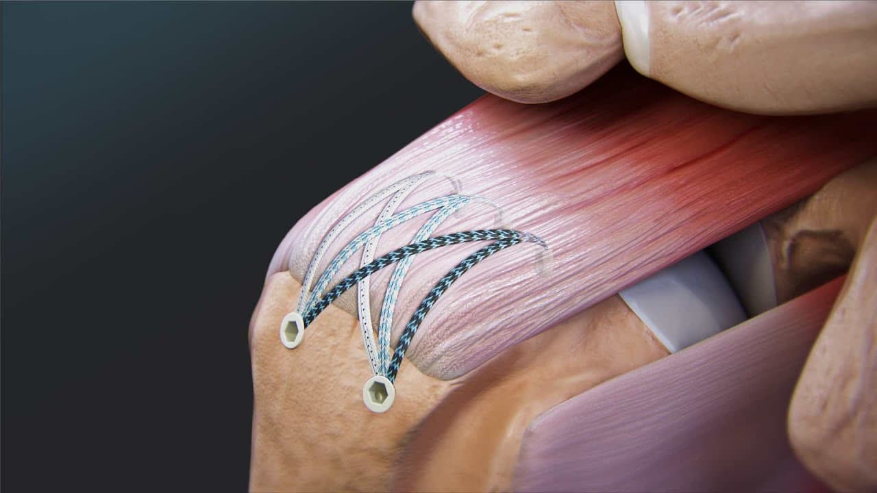 Best and Cheapest Countries for Rotator Cuff Repair Abroad