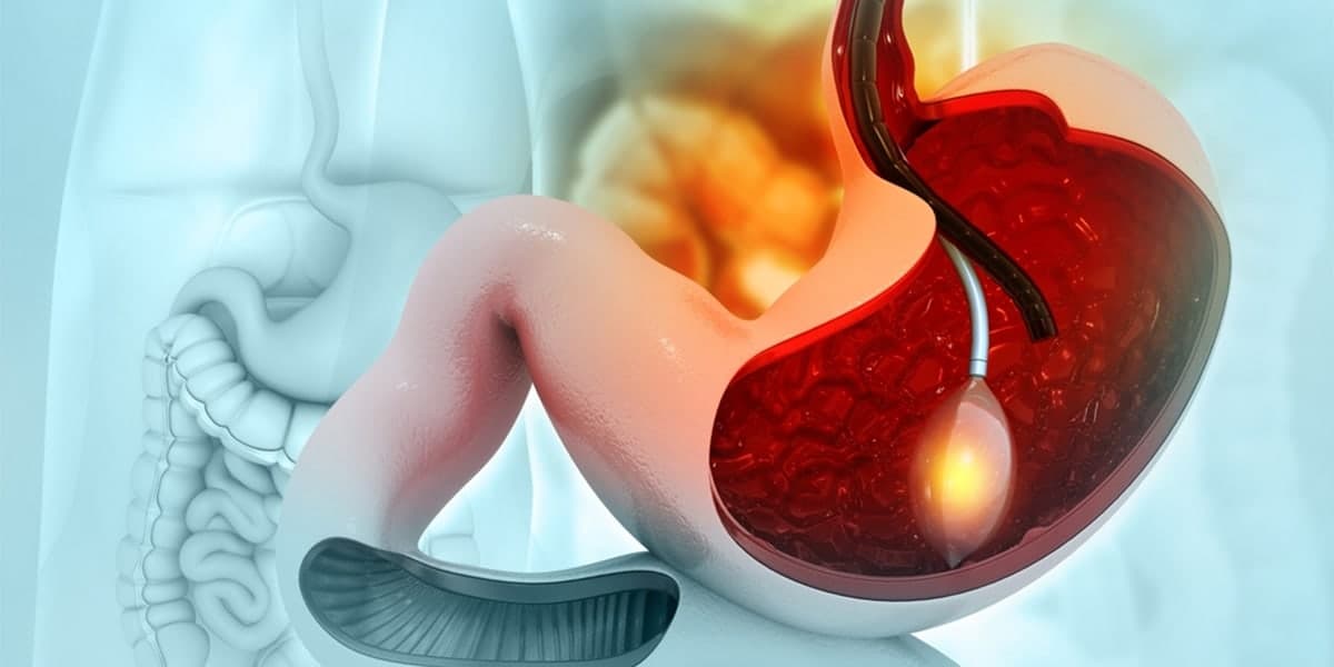Gastric Balloon In Turkey: Guaranteed Results & 2026 Costs