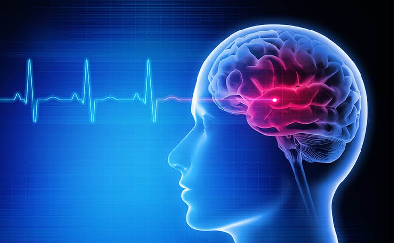 Best and Cheapest Countries for Stroke Treatment Abroad