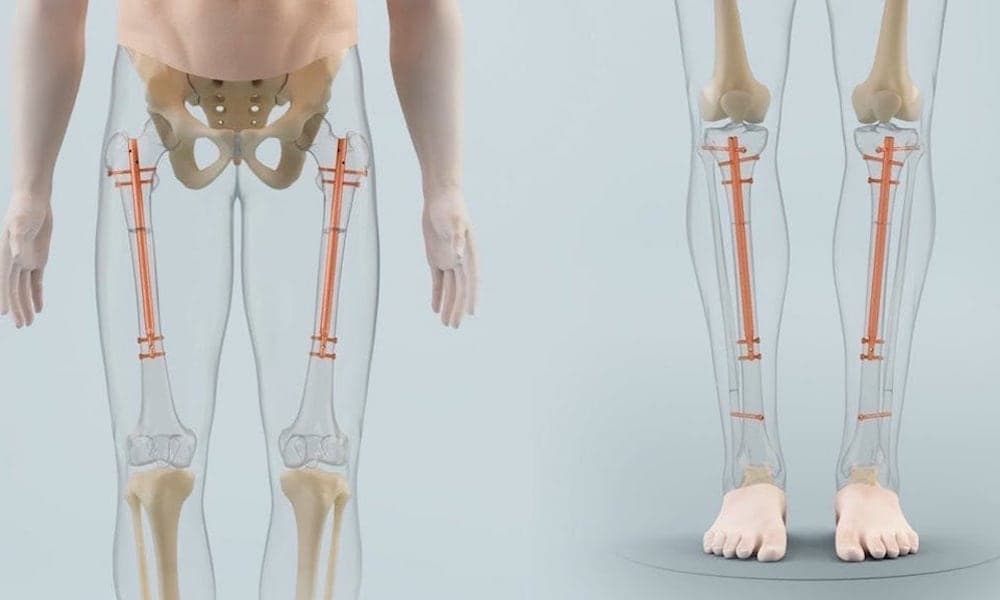 Best and Cheapest Countries for Limb Lengthening Surgery Abroad