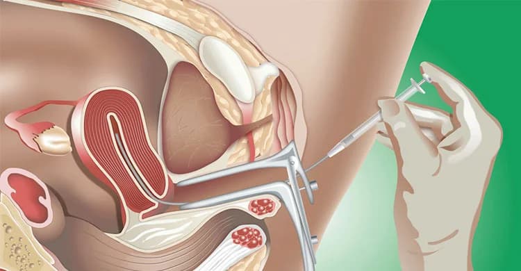 IUI Treatment in Turkey