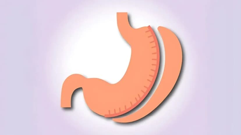 Revision Bariatric Surgery Turkey | 2026 Costs & Clinics