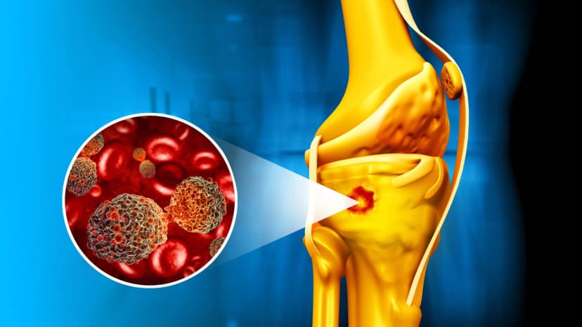 Bone Cancer Treatment in Turkey