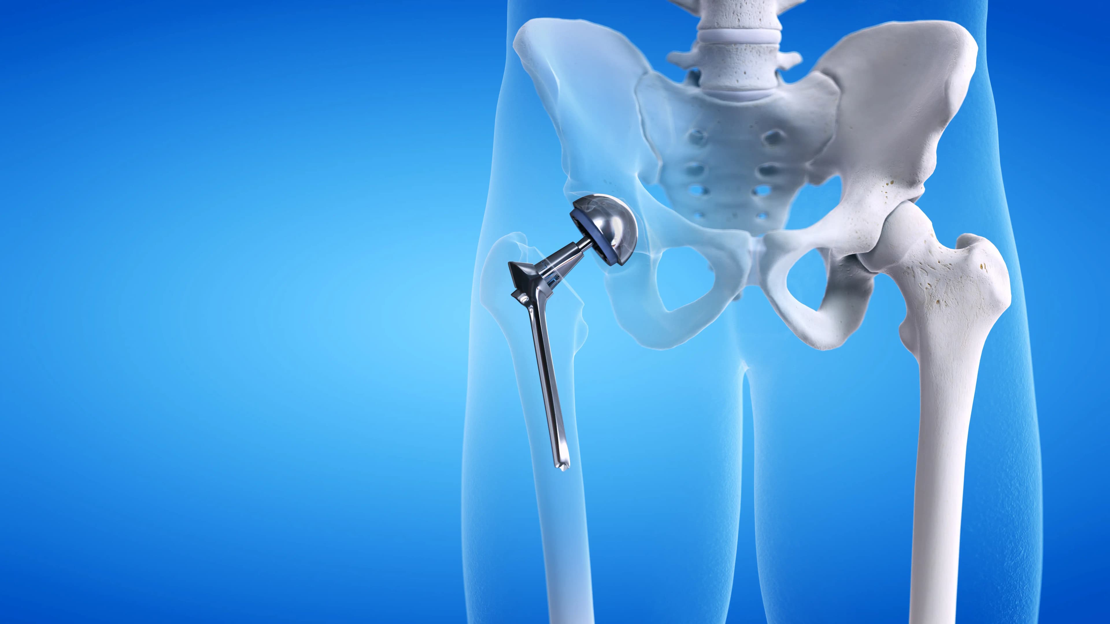Hip Replacement Surgery in Turkey: Cost, Best Hospitals & Recovery [2026]