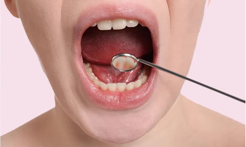 Oral Cancer Treatment in Turkey