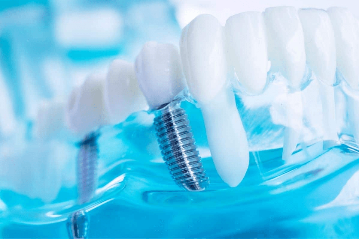 All-on-8 Dental Implants in Turkey