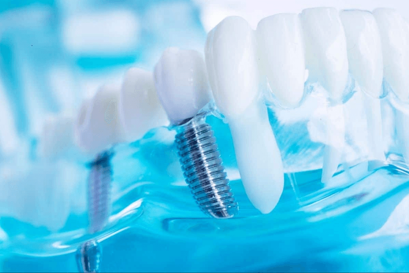 All-on-8 Dental Implants in Turkey