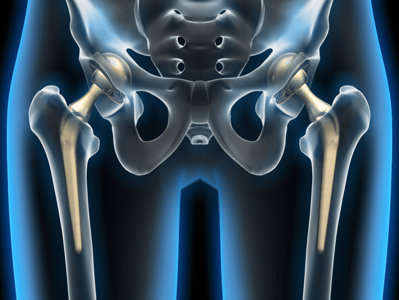 Hip Replacement in Croatia