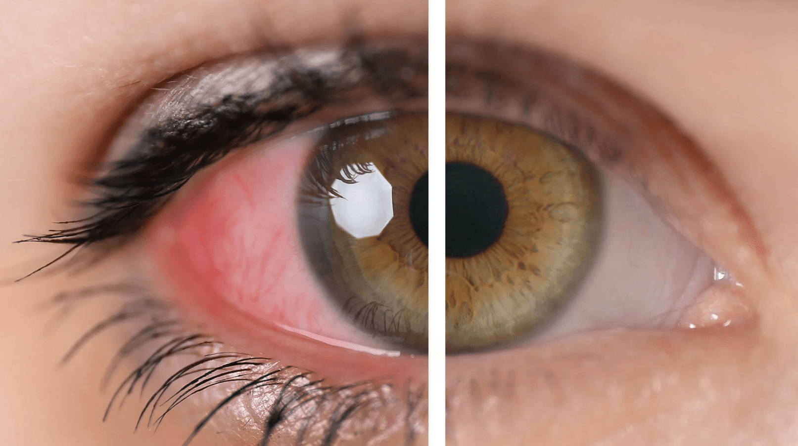 Glaucoma Surgery Abroad