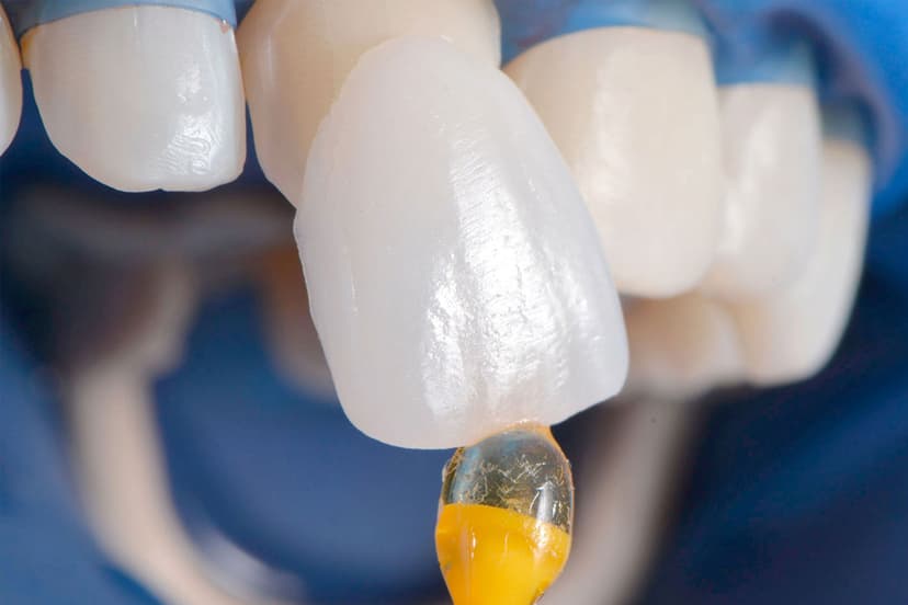 Laminate Veneers in Turkey