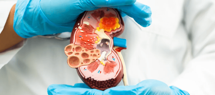 How Much Does a Kidney Transplant Cost?