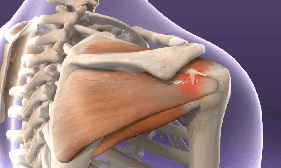 Shoulder Replacement in Croatia