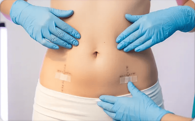 360 Liposuction in Turkey