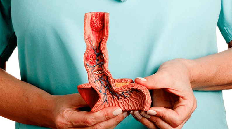 Esophageal Cancer Surgery