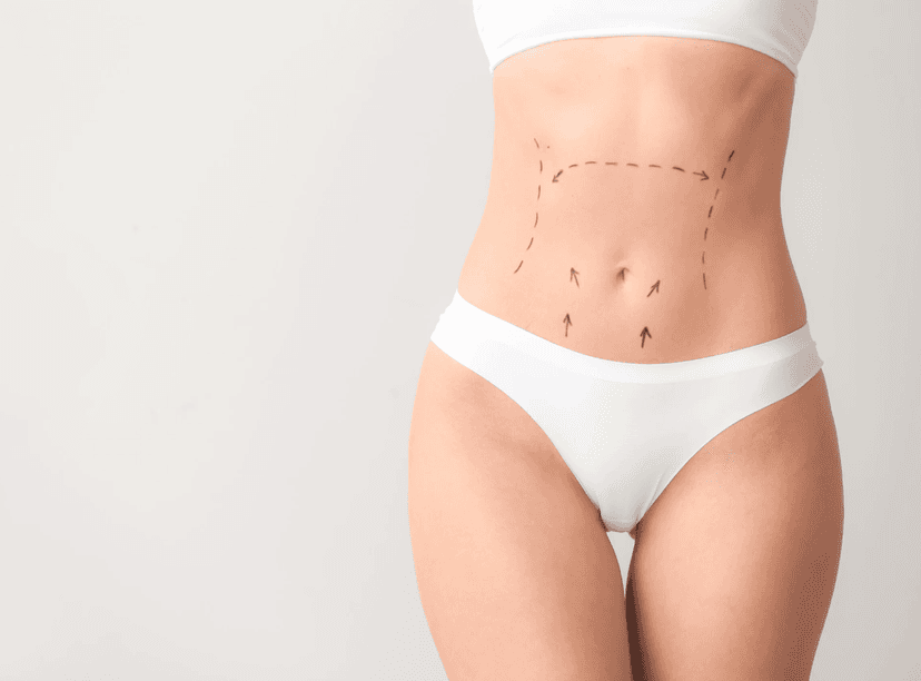 Vaser Liposuction in Turkey