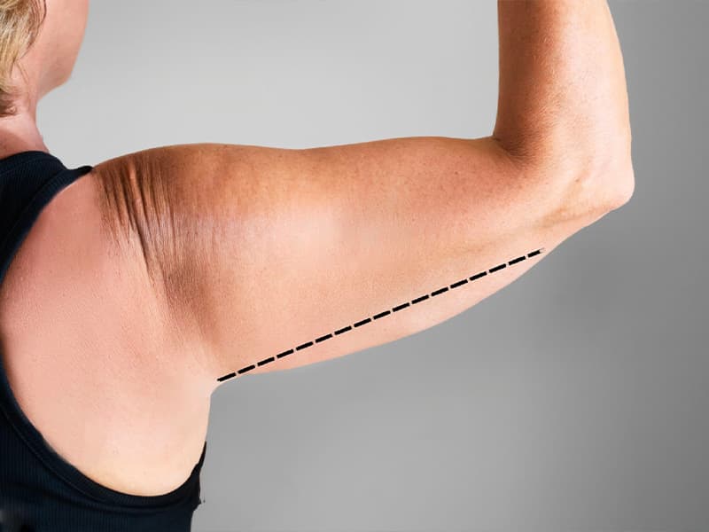 Arm Lift (Brachioplasty) in Turkey