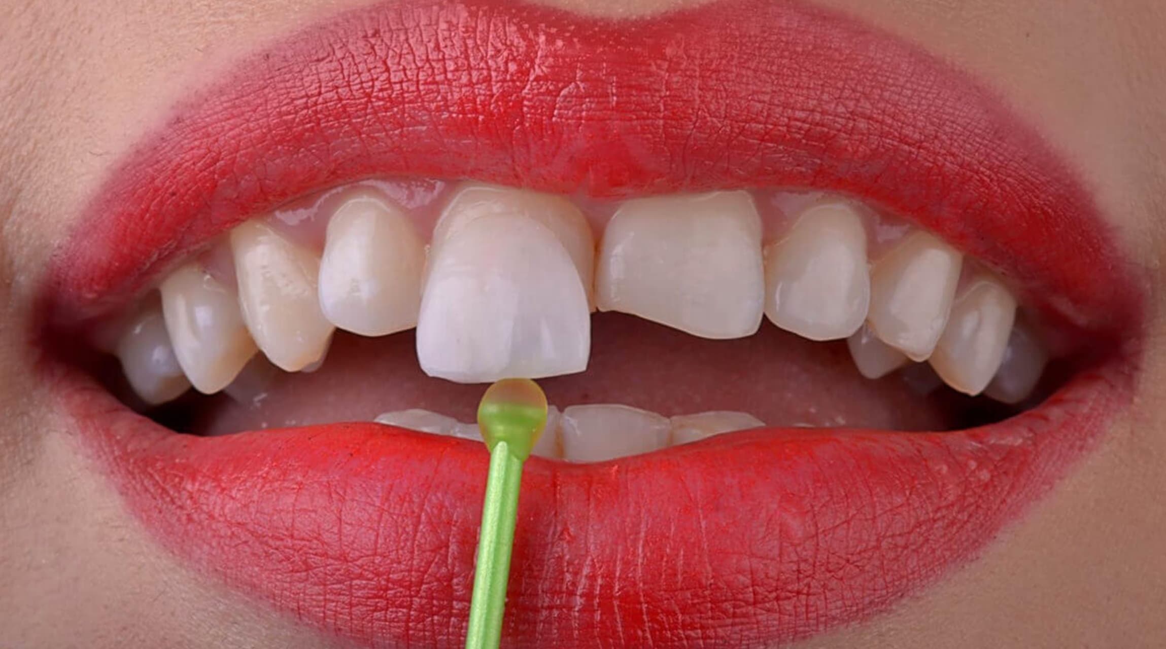 Emax Veneers in Turkey