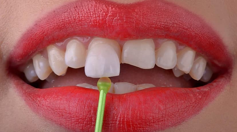 Emax Veneers in Turkey