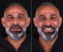 Bagcilar Dental Clinic - Before/After 4
