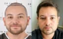 Drterziler clinic - Before/After 2