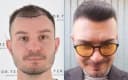 Drterziler clinic - Before/After 3