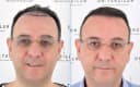 Drterziler clinic - Before/After 4