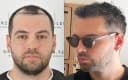 Drterziler clinic - Before/After 1