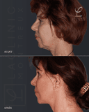 La Clinic - Before/After 3