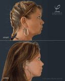 La Clinic - Before/After 4